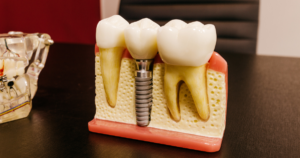Can dental implants come loose